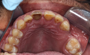 Open apex management - Procedure photo Case 1